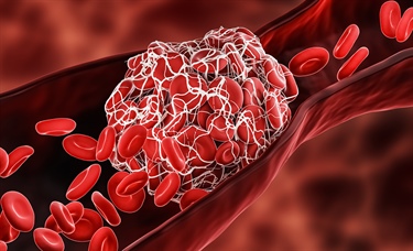 Rapid response required for COVID-19 vaccine-associated thrombocytopenia